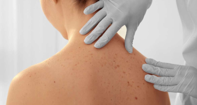 DERMATOLOGJI KLINIKE