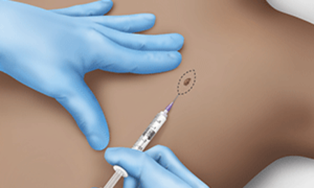 KIRURGJIA DERMATOLOGJIKE